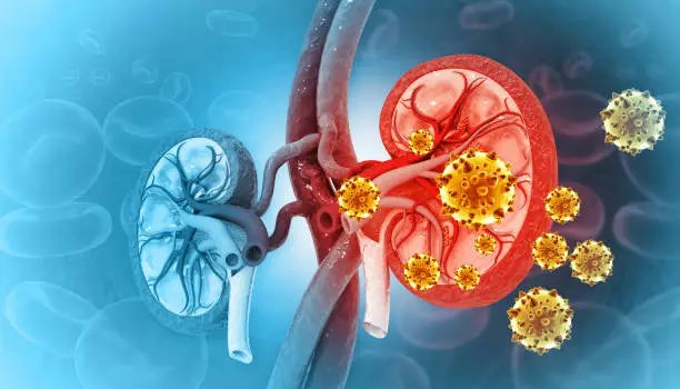 Kidney Stone